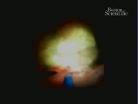 SpyGlass DS直视胆道镜系统在胆道疾病诊治中的初步临床研究