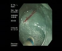 内镜注水泵用于贲门失弛缓症经口内镜下肌切开术治疗